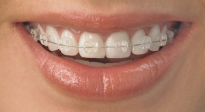 What To Expect From An Orthodontic Treatment