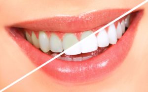 Benefits of Teeth Whitening